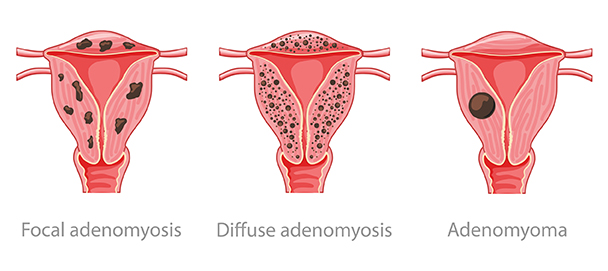 adenomyosis.jpg